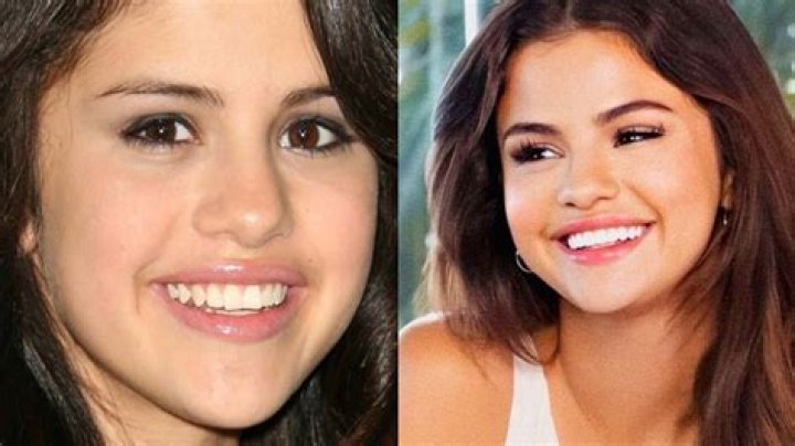 Does Selena Gomez Have Veneers? New Teeth Before And After