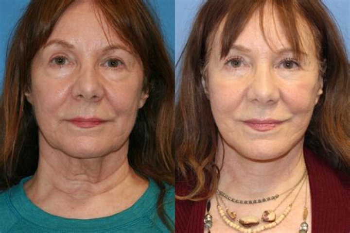 Embeth Davidtz Plastic Surgery: Before And After Photos