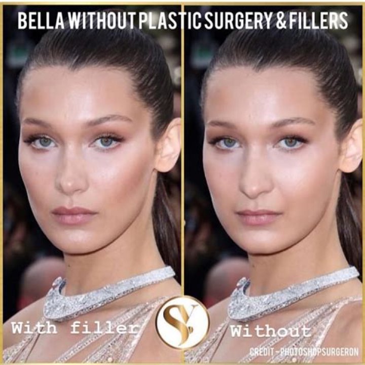 What Sort of Plastic Surgery Did Bella Hadid Actually Have? Disclosing the Details